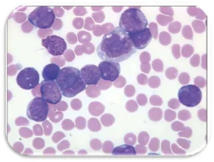 Acute myelomonocytic leukemia