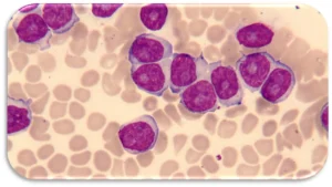 PLL(Pro lymphocytic leukemia)