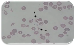 Hemolytic Uremic Syndrome (HUS)