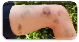 Immune Thrombocytopenic Purpura