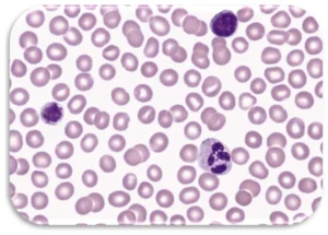 Immune Thrombocytopenic Purpura
