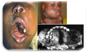 Burkitt Lymphoma