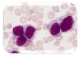 Acute myeloid leukemia